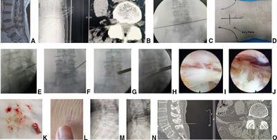 Efficacy and safety of percutaneous transforaminal endoscopic surgery (PTES) compared with MIS-TLIF for surgical treatment of lumbar degenerative disease in elderly patients: A retrospective cohort study